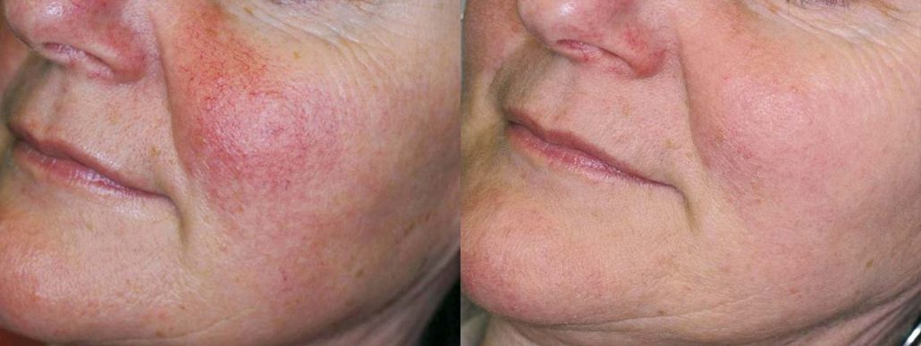 A before and after photo of IPL (intense pulsed light) used on the face to reduce redness