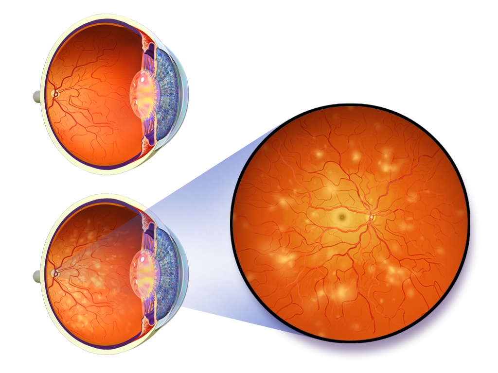 A diagram shows an image of an eye affected by diabetes