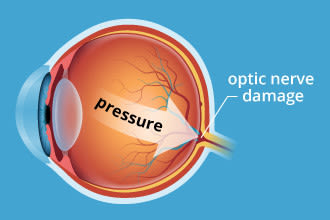 An image of an eye shows optic nerve damage from glaucoma