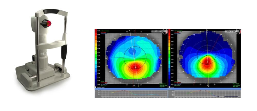 Diagnostic imaging of an eye with keratoconus