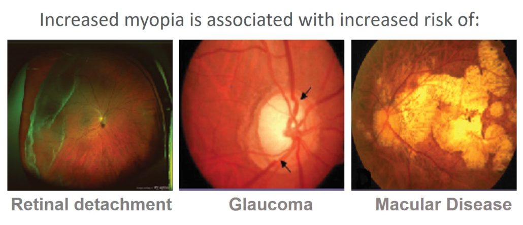 Three images show how untreated myopia can worsen into retinal detachment, glaucoma, and macular disease.