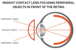 An image showing how contact lenses help to focus peripheral objects in front of the retina