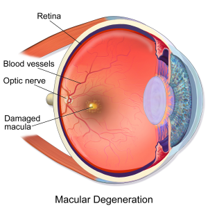 Eye diagram shows macular degeneration