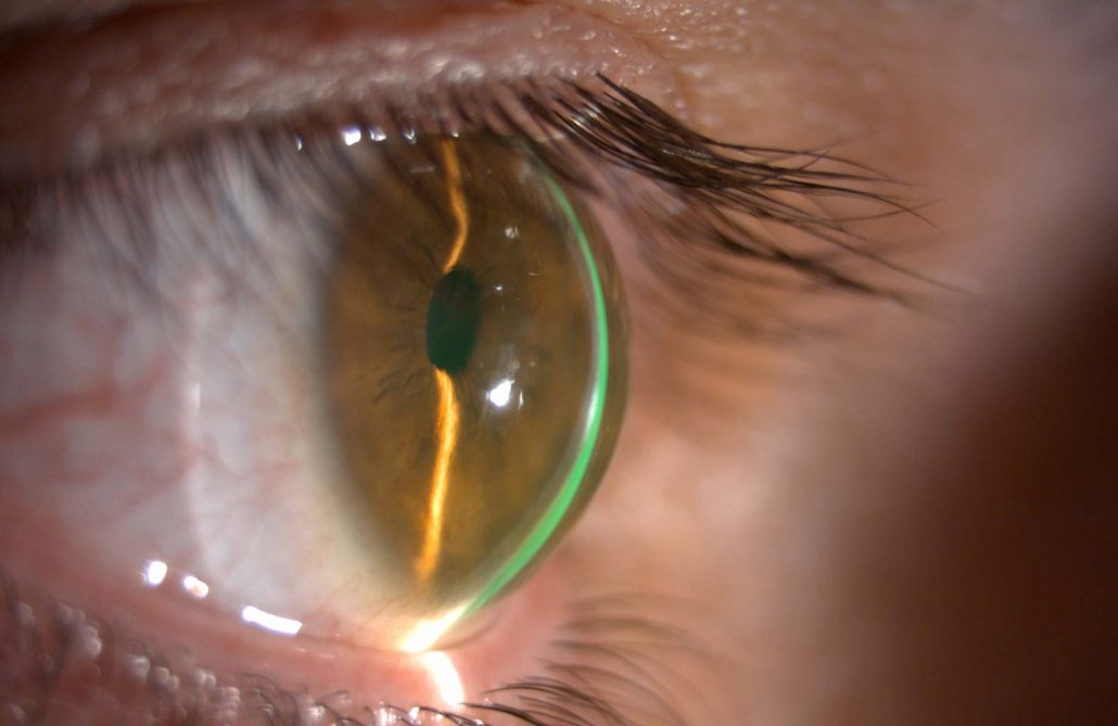 A patient's eye is fitted with a scleral contact lens to treat corneal disease like keratoconus.