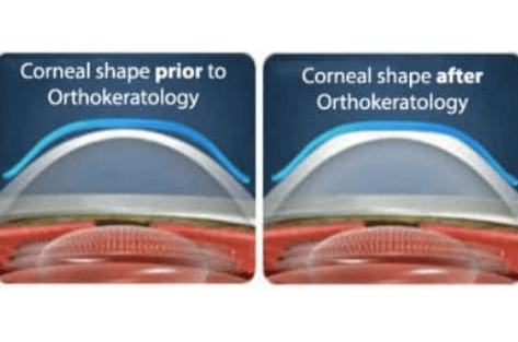 Side by side comparison shows how orthokeratology can reshape the cornea