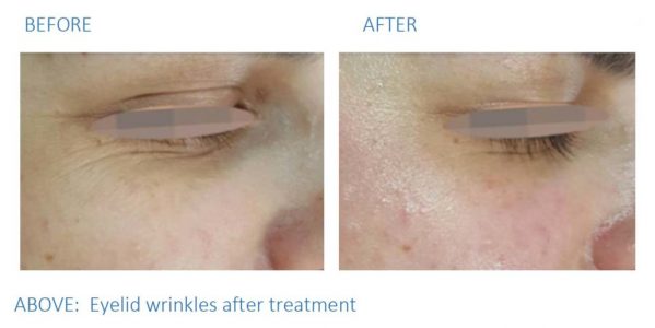 A before and after photo showing how radio frequency reduces wrinkles on the eyelids